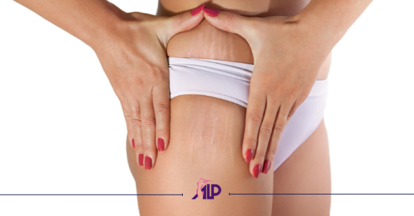 درمان استرچ مارک