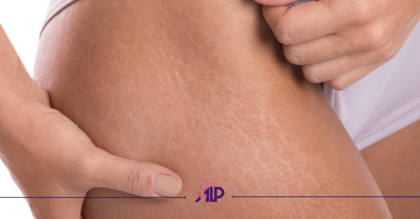 درمان ترک پوستی