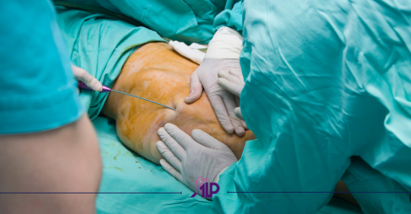 کول اسکالپتینگ و لیپوساکشن