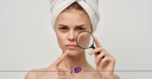 درمان جای جوش با میکرونیدلینگ