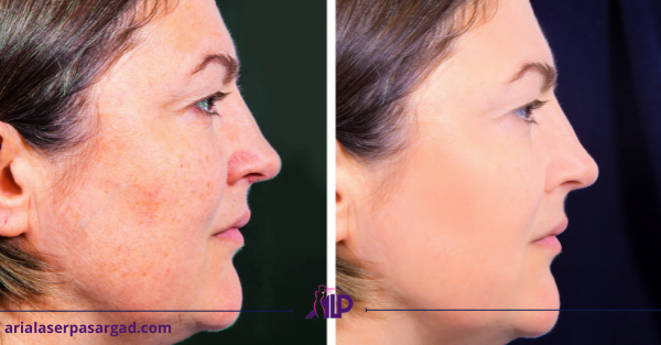 منافذ باز پوست آریا لیزر