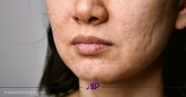 منافذ باز پوست اندولیفت