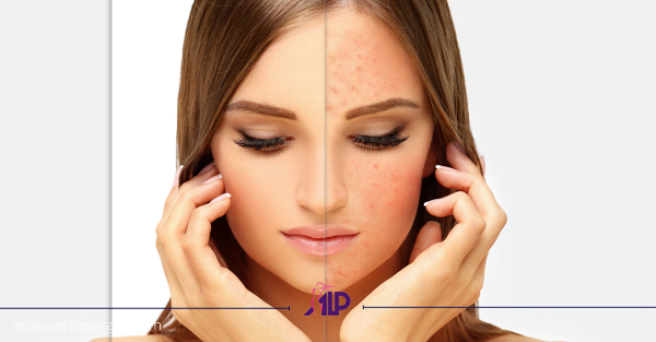 آکنه روزاسه