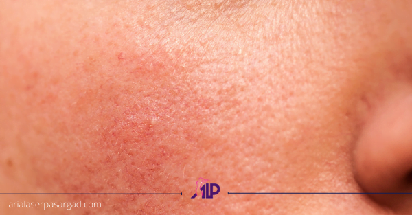 آکنه روزاسه آریا لیزر