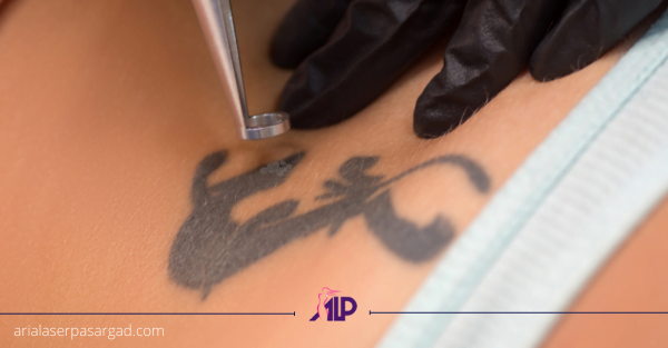 پاک کردن تتو با لیزر