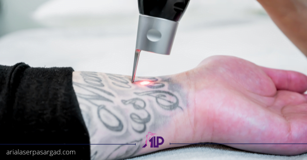 پاک کردن تتو با لیزر ndyag
