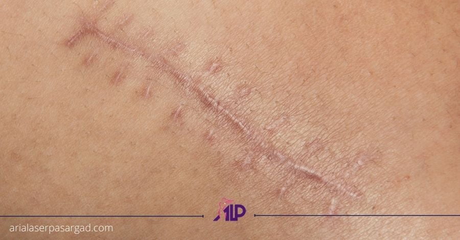 درمان اسکار صورت