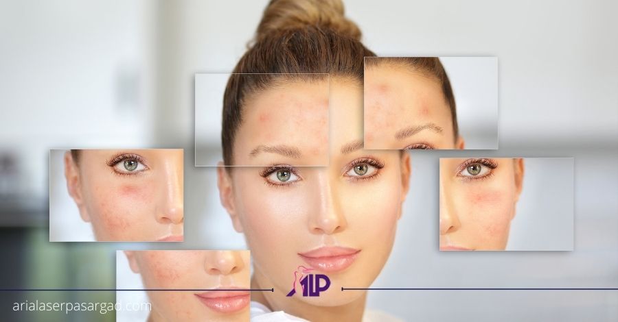 درمان اسکار صورت