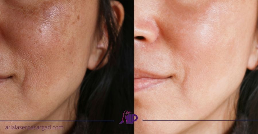 درمان ملاسما با لیزر