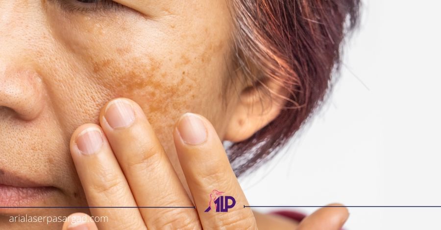 درمان ملاسما با کیوسوییچ