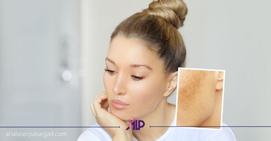 درمان ملاسما با فرکشنال