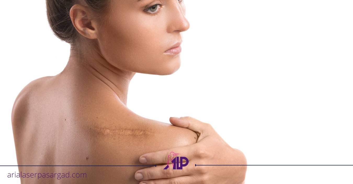 درمان جای زخم با لیزر