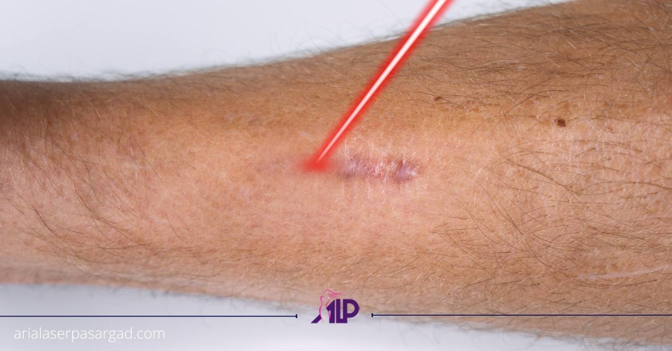 درمان اسکار با لیزر