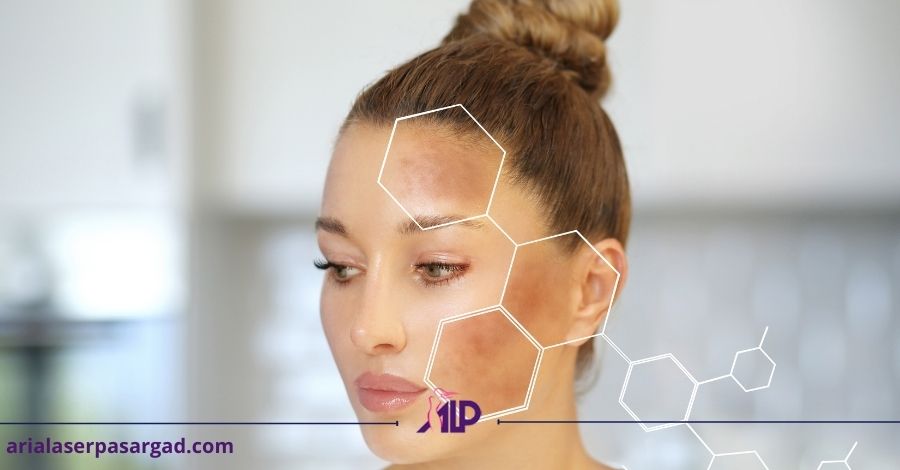 هایپرپیگمنتیشن درمان