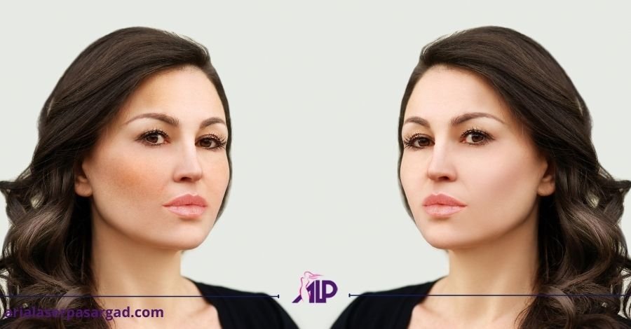 درمان هایپرپیگمنتیشن با لیزر