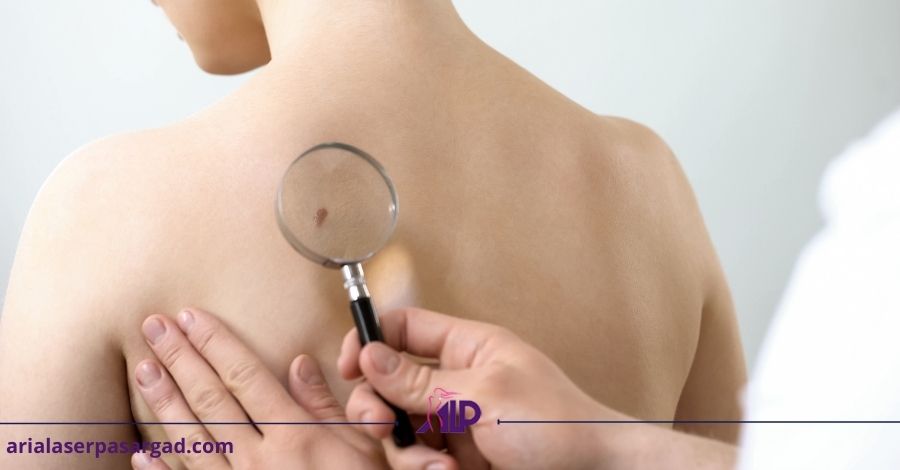 خال و درمان آن