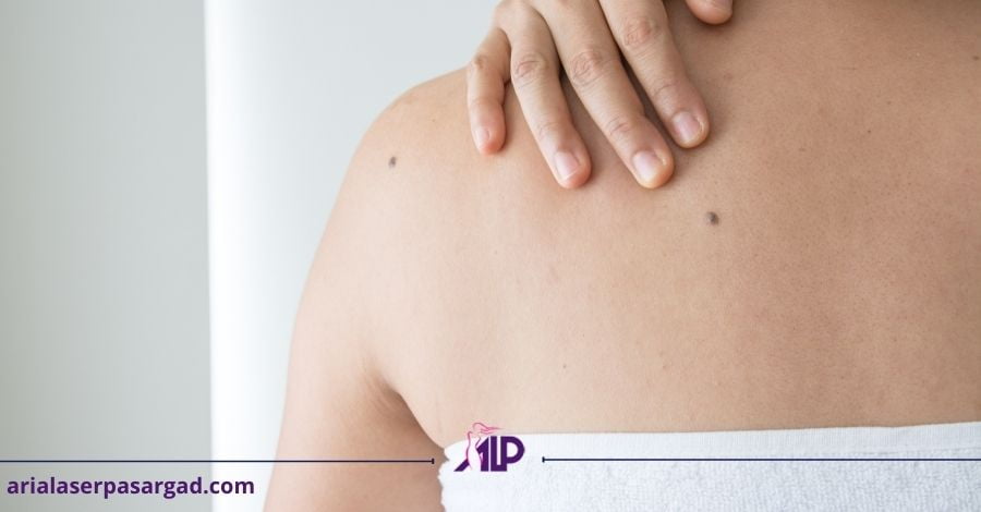 خال و روش درمان آن