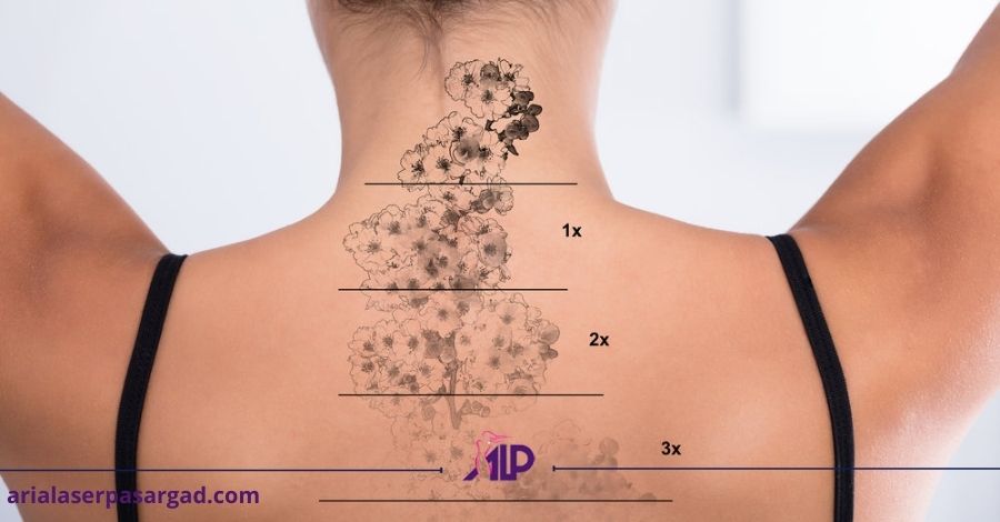 پاک کردن تاتو