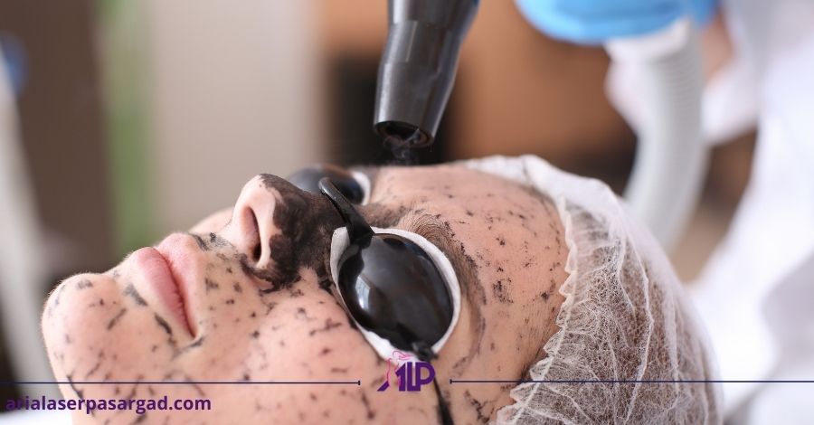 پیلینگ کربن با لیزر