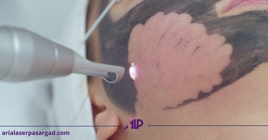 پیلینگ کربن