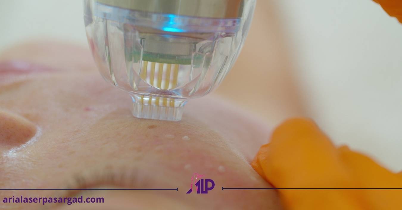 عوارض میکرونیدلینگ