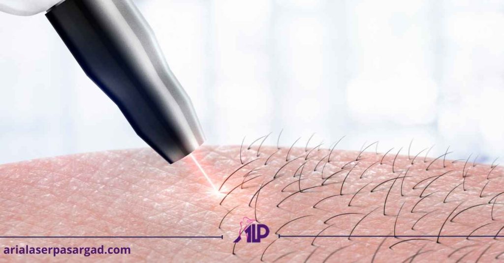لیزر موی زائد سفید و خاکستری