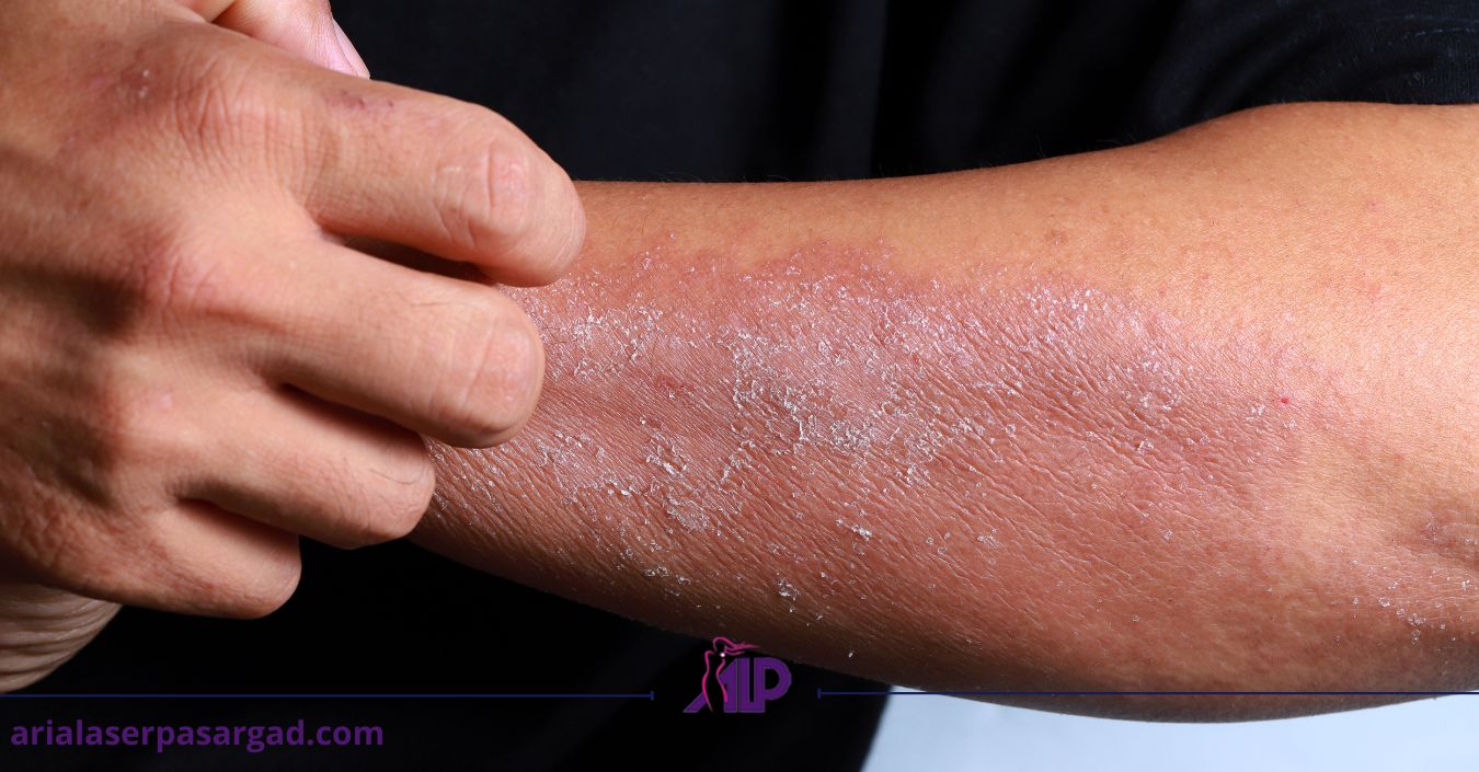 همه چیز درباره اگزما