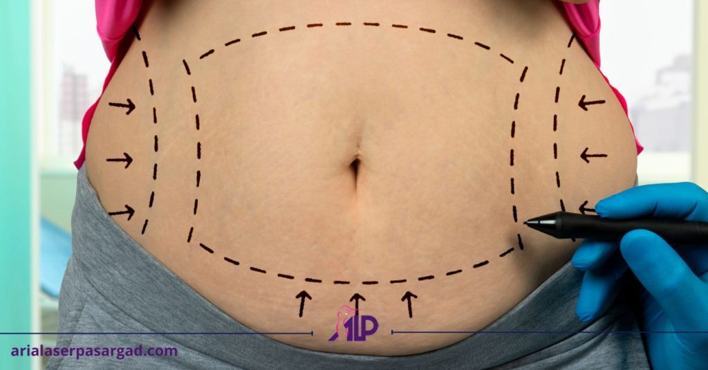 لیپوماتیک چیست؟