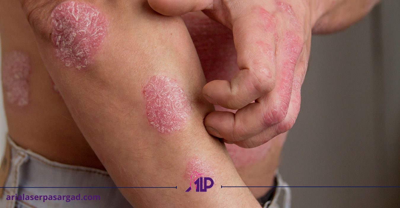 پسوریازیس دست