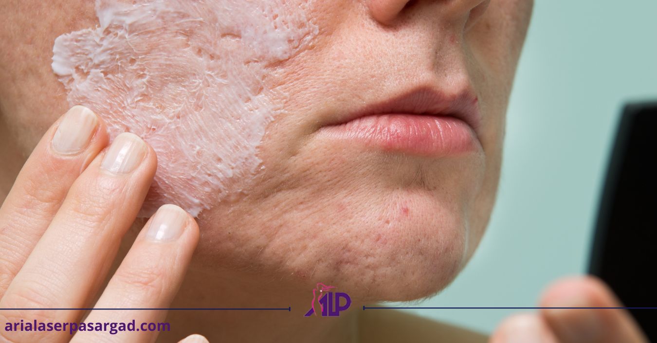 جوش هورمونی