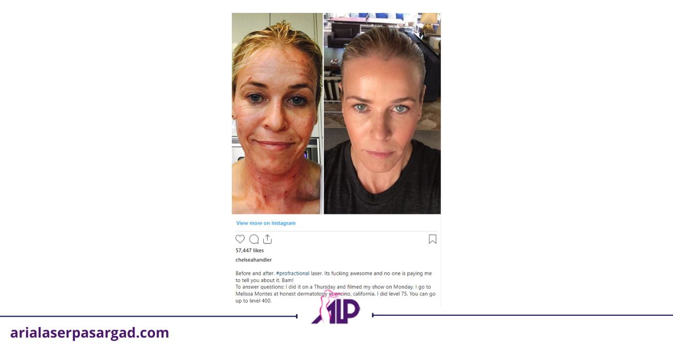 درمان لیزر co2 فرکشنال