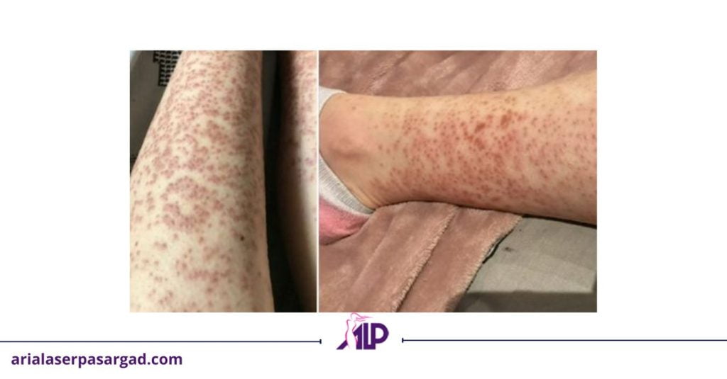 سوختگی لیزر موی زائد