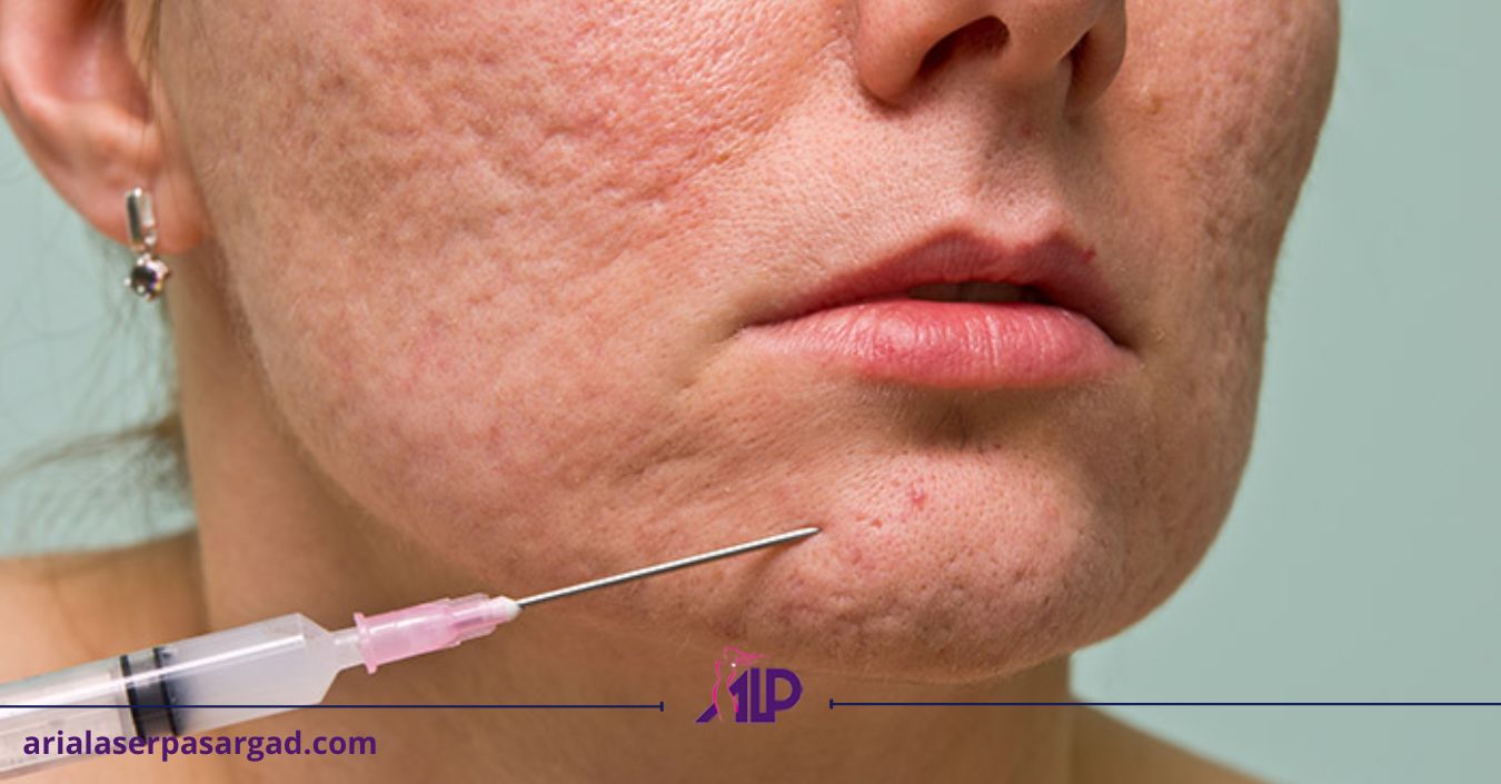 فرورفتگی های پوستی