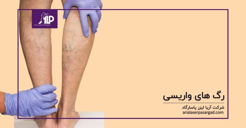 درمان رگ های واریس با لیزر