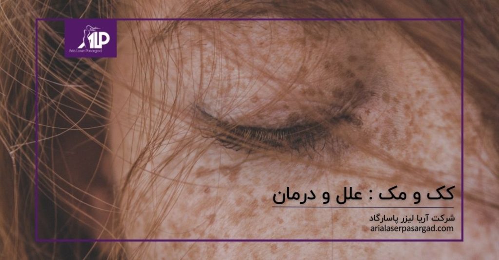 درمان کک و مک با لیزر
