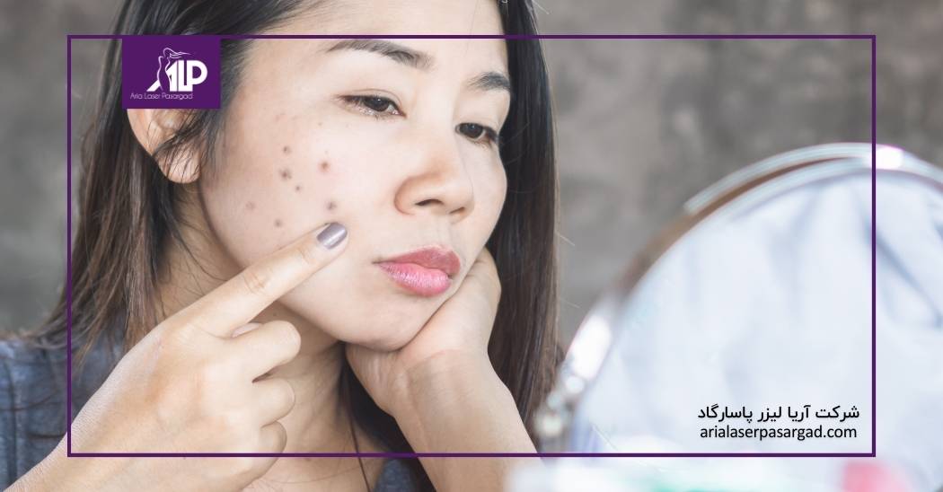 درمان لکههای پوستی