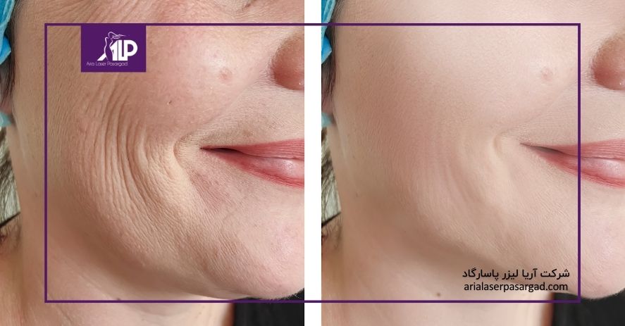 چین و چروک صورت